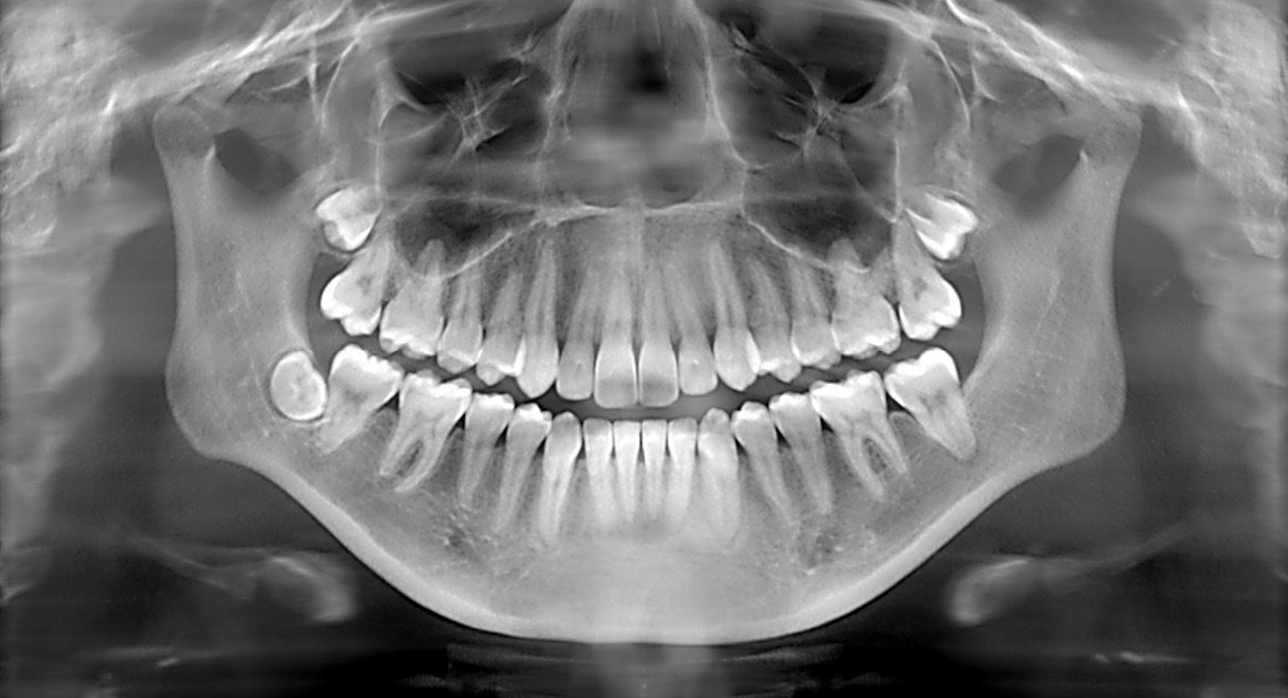 Dental X-Ray